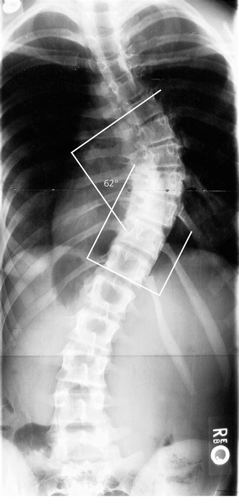 Adolescent Idiopathic Scoliosis Diagnosis And Management Aafp