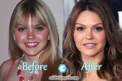 Aimee Teegarden Plastic Surgery, Before and After Nose Job Pictures ...