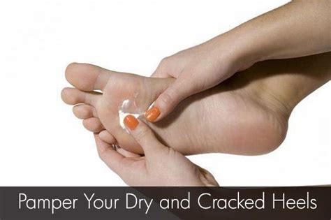 Dry Cracked Feet And How To Fix Them Dry Cracked Feet Cracked Feet