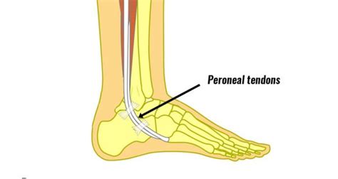 Peroneal Tendon Dislocation Symptoms Causes Treatment And Rehab