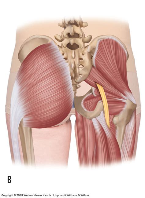 Piriformis Syndroom