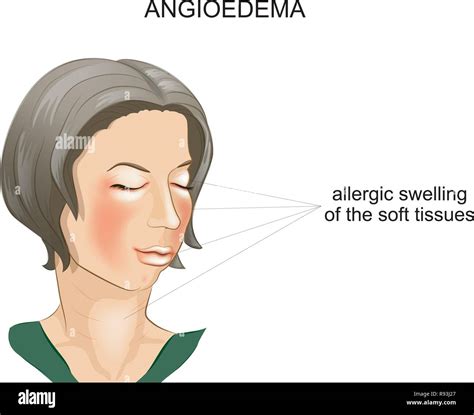Vector Illustration Of Angioedema Allergic Swelling Of The Soft