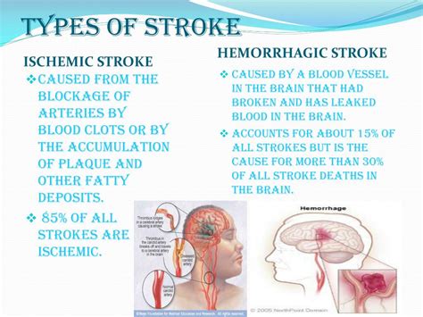Ppt Stroke Powerpoint Presentation Free Download Id3108569