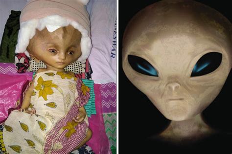 Baby With Worlds Biggest Head Stuns Medics In India As Skull Swells To