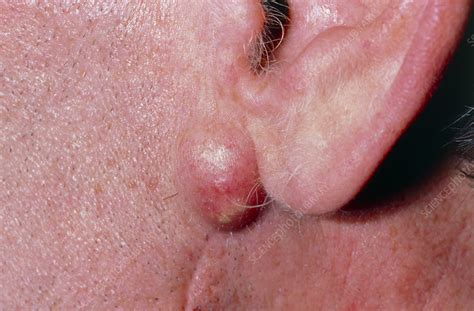 Infected Sebaceous Cyst On Mans Jaw Under Ear Stock Image M130