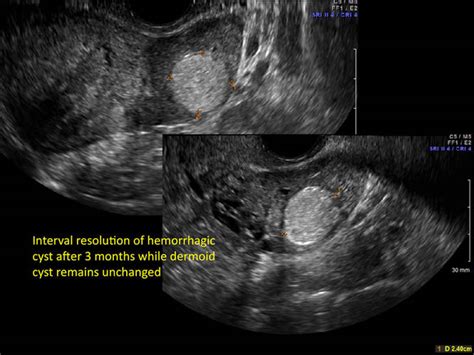 Hemorrhagic Ovarian Cysts One Entity With Many Appearances Mdedge Obgyn