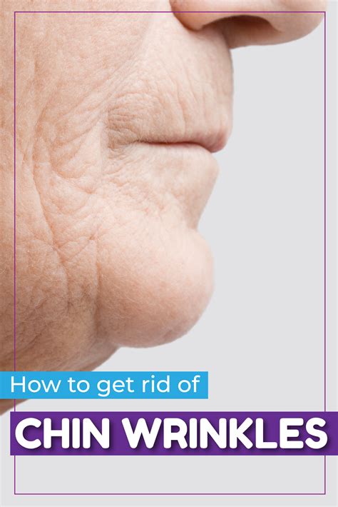 How To Get Rid Of Chin Wrinkles Chin Wrinkles Skin Dryness Wrinkles