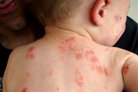 Eczema On Babies Find Out How To Get Rid Of Childs Eczema Using