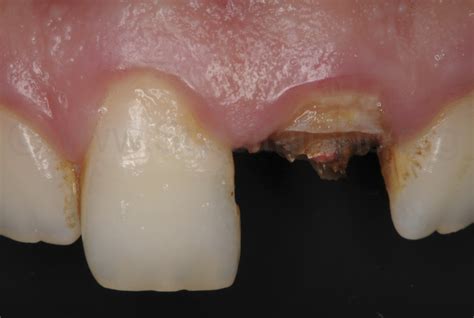 Immediate Provisional Restoration Of A Complete Crown Fracture