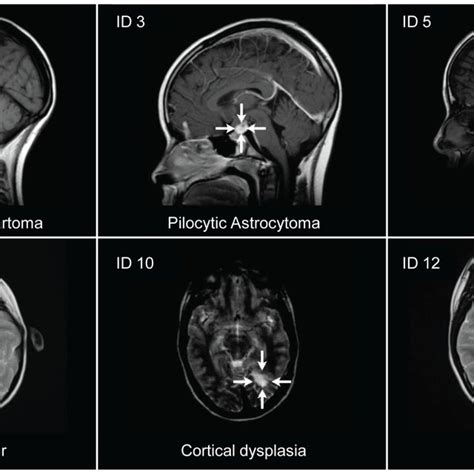 Brain Mri Of Newly Diagnosed Pathology Pathological Brain Mri Scans