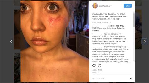 Nashville Country Star Meghan Linsey Shares Horrifying Spider Bite