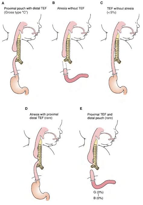 Esophageal Atresia And Tracheoesophageal Fistula TEF A Proximal