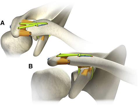 Treatment Of Symptomatic Acromioclavicular Joint Instability By A