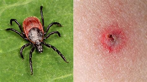 7 Tick Bites That Can Make You Sick Everyday Health