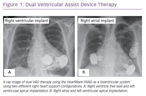 Choosing Between Left Ventricular Assist Devices And Biventricular