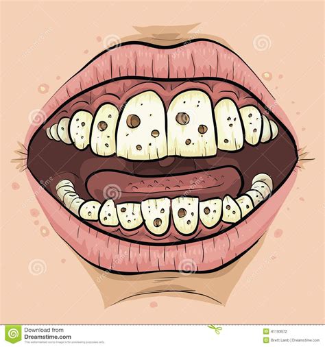 Cartoon Cavities Stock Illustration Illustration Of Tooth X Jpeg Teeth
