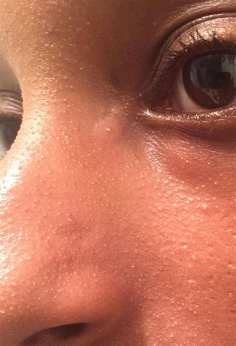 Skin Concerns How Can I Get Rid Of These Tiny Bumps On My Nose Ive
