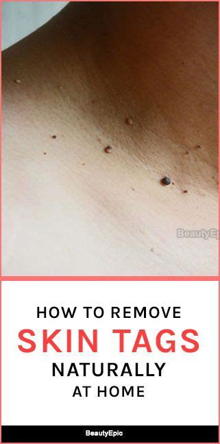 how to remove skin tags naturally at home artofit