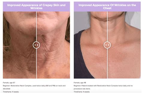 Do You Want To Improve Crepey Skin Fine Lines And Wrinkles Outer