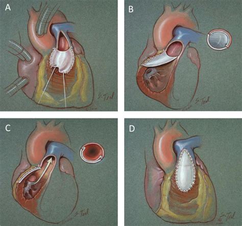 Right Ventricular Outflow Tract Reconstruction With A