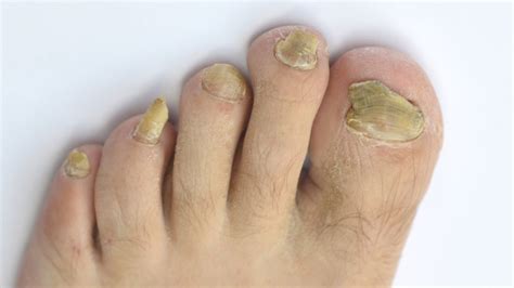 Toenail Fungus Gives Up Sex To Infect Humans Iflscience