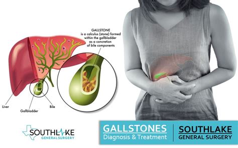 Gallbladder Diseases Types Symptoms And Treatment Southlake Texas The