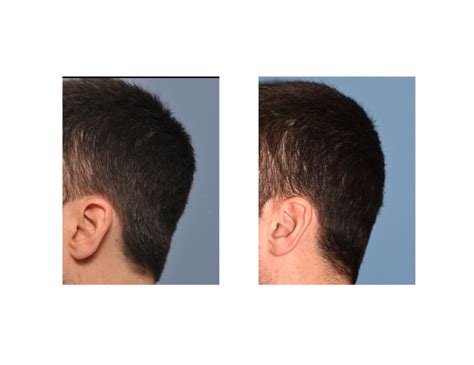 Plastic Surgery Case Study Occipital Skull Reduction Explore