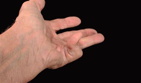Dupuytrens Contracture 10 Things Doctors Want You To Know Dupuytren