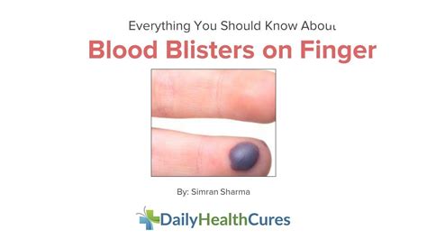 10 Home Remedies To Treat Blood Blister On Finger Youtube