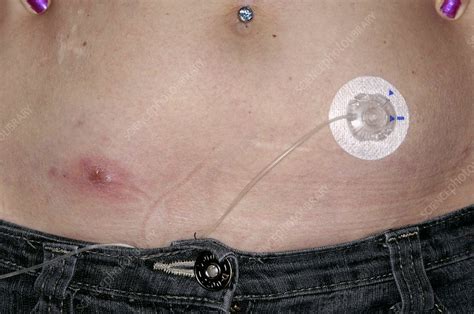 Abscess On The Abdomen Stock Image C004 2390 Science Photo Library