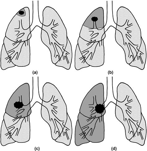 Postoperative Complications Of Pulmonary Resection Clinical Radiology