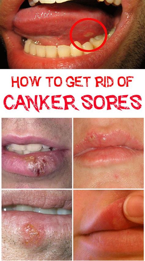 How To Get Rid Of Canker Sores On Tongue Beauty Tricks Canker Sore