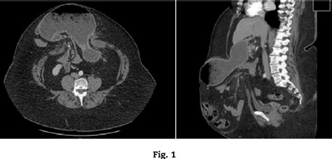 Figure 1 From Giant Incisional Hernia Containing The Stomach And Bowel