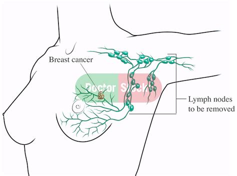 Lymph Nodes In Armpit Diagram