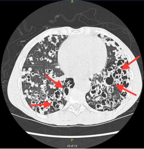 Cureus Recurrent Pneumocystis Pneumonia With Uncommon Radiographic