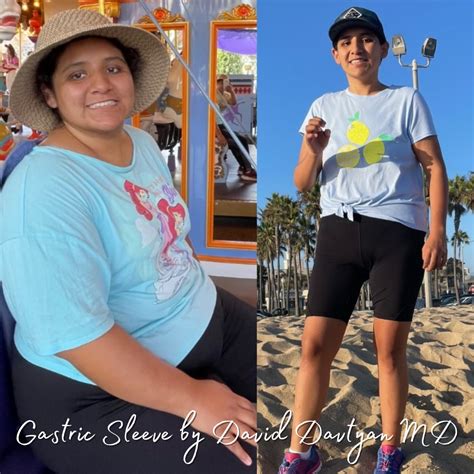 Gastric Sleeve Before And After Photos