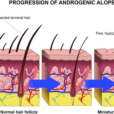 Progression Of Androgenic Alopecia The Hair Follicles Are Miniaturized
