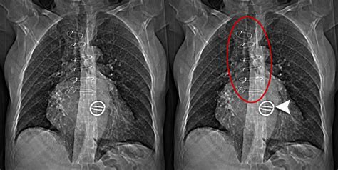 Chest X Ray Devices And Artifacts Mitral Valve Replacement