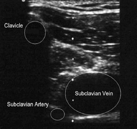 Subclavian Vein Ultrasound