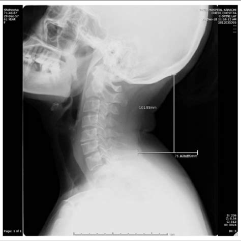 X Ray Cervical Spine Lateral View Demonstrating Radiological
