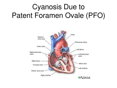 Patent Foramen Ovale Causes Symptoms Treatment Patent