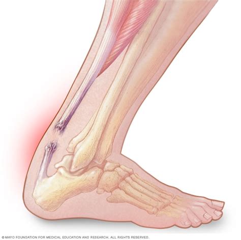 Healed tendon can be stronger but is stiffer and reduces perfo… horses and companion animals. Achilles Tendon Tears - Rural Physio at Your Doorstep ...