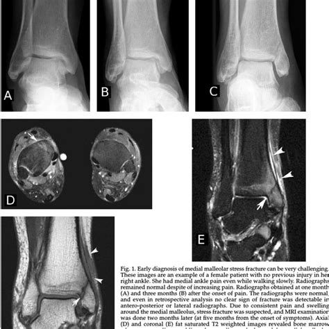 Pdf Medial Malleolar Fractures And Associated Deltoid Ligament My Xxx