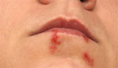 6 Effective Remedies For Treating Cold Sores