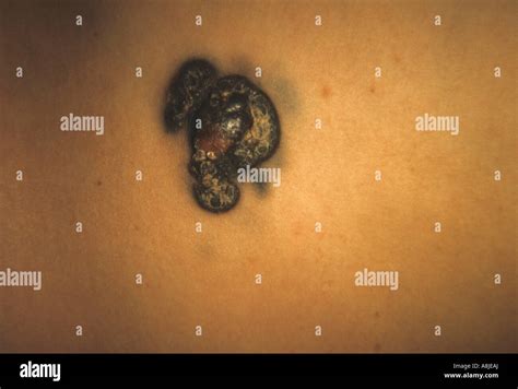 Nodular Malignant Melanoma Cancer Stock Photo Alamy