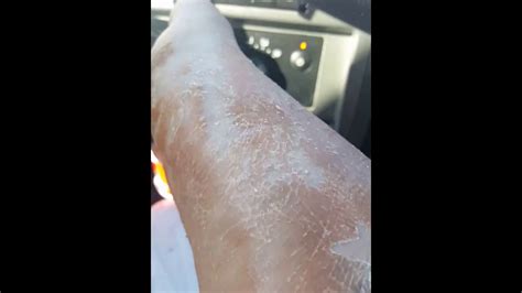 Post Cast Removal Dry Skin Peel Youtube