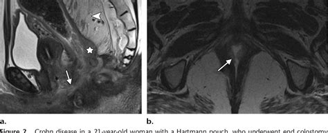 Figure 2 From Imaging And Surgical Management Of Anorectal Vaginal