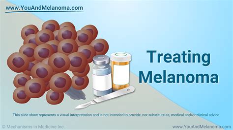 Slide Show Treating Melanoma