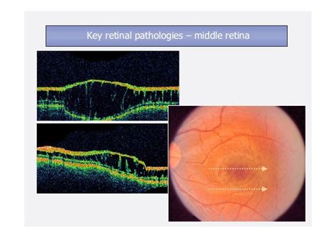 İnterpretation Of Optic Coherence Tomography Images