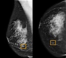 A.I. Is Learning to Read Mammograms - The New York Times